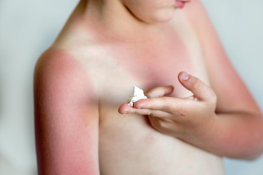 Слънчева алергия при децата.