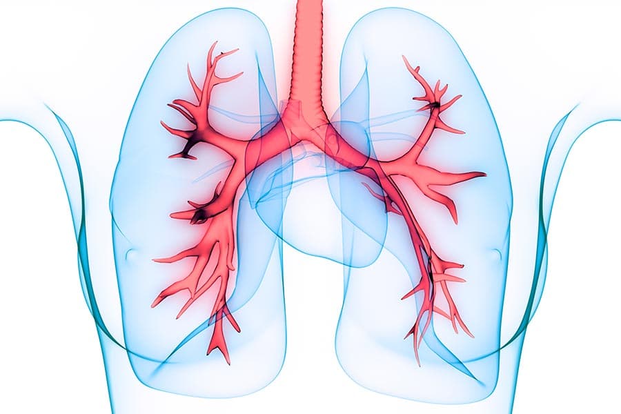 Витамин D срещу COVID-19. Пневмония - респиратовно заболяване на белите дробове.
