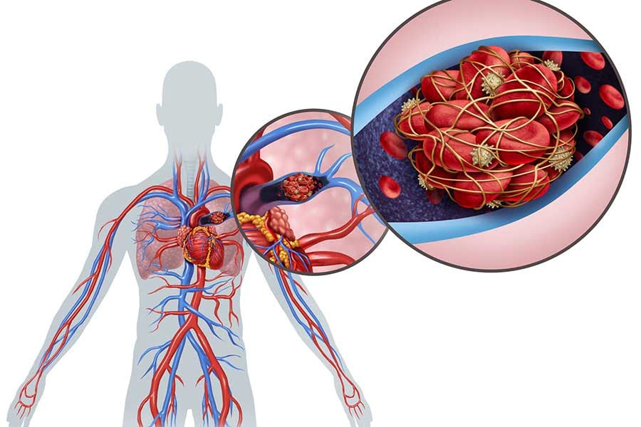 policitemia-vera-Pulmonary-Embolism-Anatomy Полицитемия вера. Белодробен тромбембелизъм.
