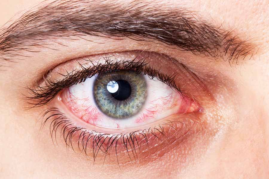 Болестни сигнали. Причини за кръвоизлив в окото.