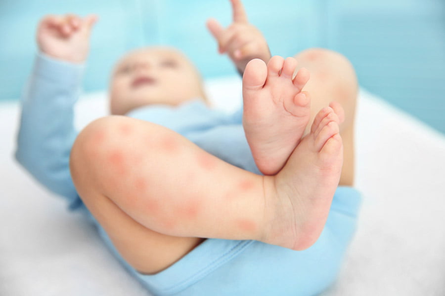 Алергени при бебета и деца.