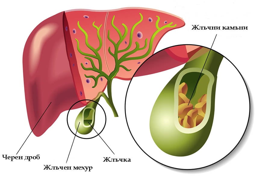 Проблеми с жлъчката, камъни в жлъчката.