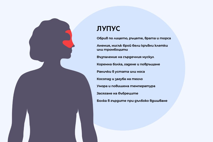 Зони лупус