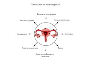 Тестостерон и ендометриоза, връзката.