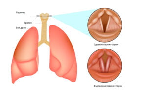 Остри респираторни инфекции на горните дихателни пътища.