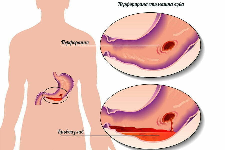 Кървене от стомаха, язва.