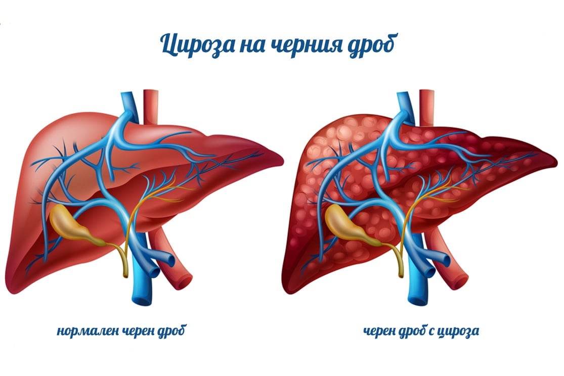 Възпалителни заболявания на червата. Цироза на черния дроб.