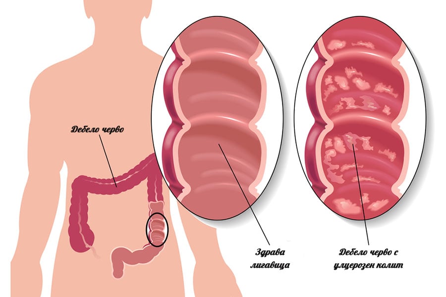 Улцерозен колит, възпаление на дебелото черво.