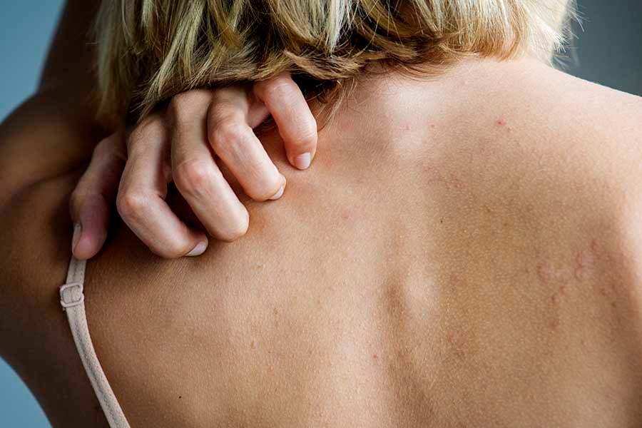 herpes-zoster-lechenie-simptomi Херпес зостер, белези, симптоми.
