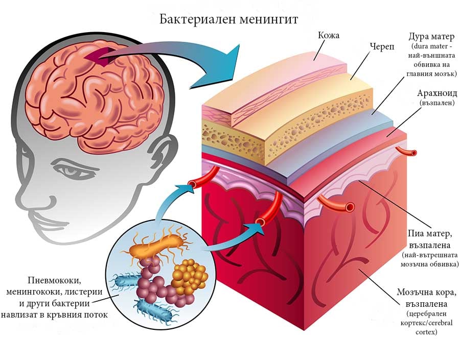 Менингит, възпаление, главоболие.