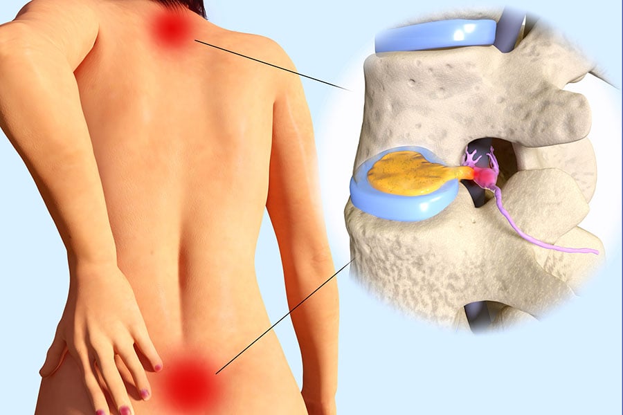 Дискова херния.