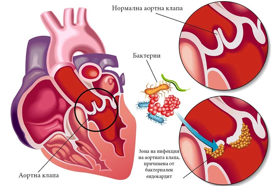 Ендокардит, сърдечни клапи, бактерии.
