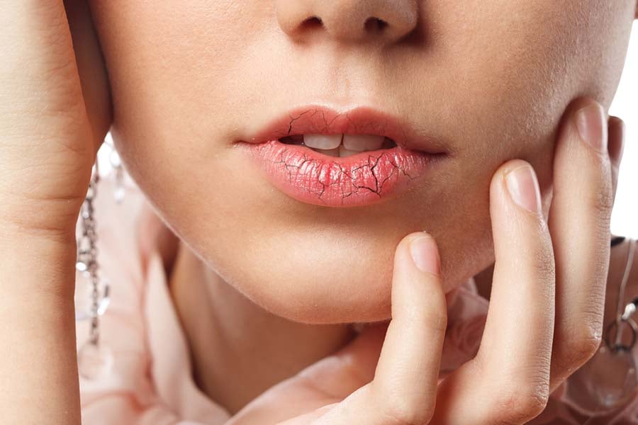 напукани-устни