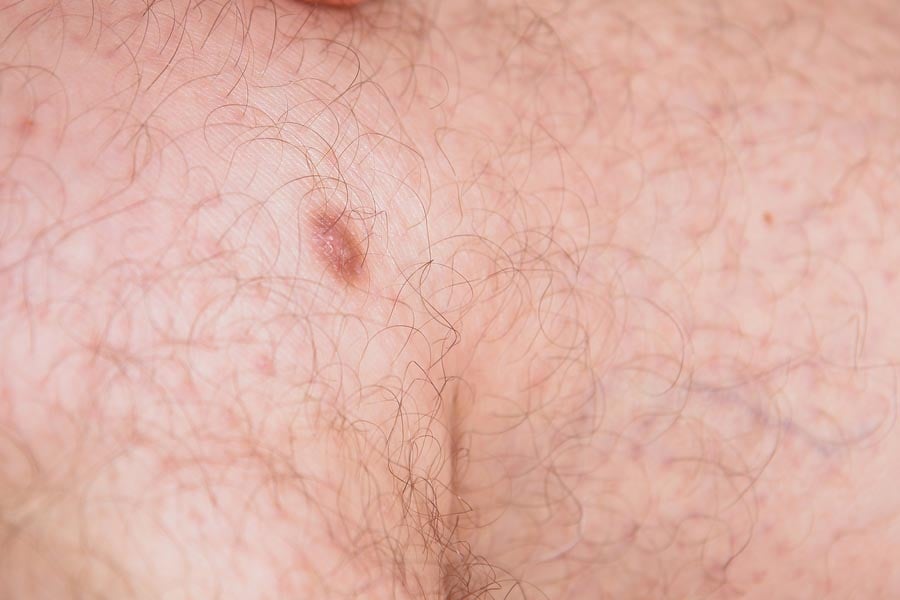 дерматофибром