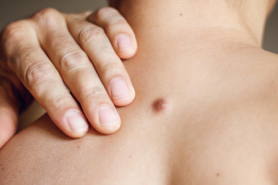 дерматофибром