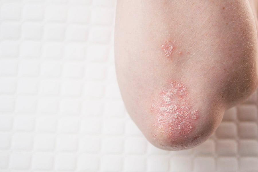 Сухи лакти - как да се погрижим за загрубялата кожа? 11 Сухи лакти.