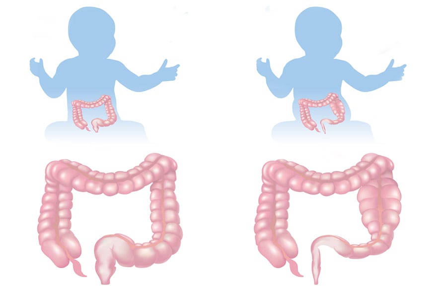 Болест на Хиршпрунг.