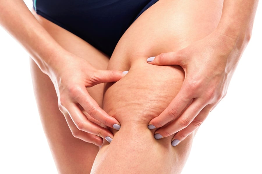 Антицелулитен масаж.