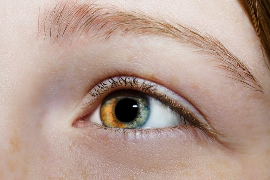 Частична хетерохромия.