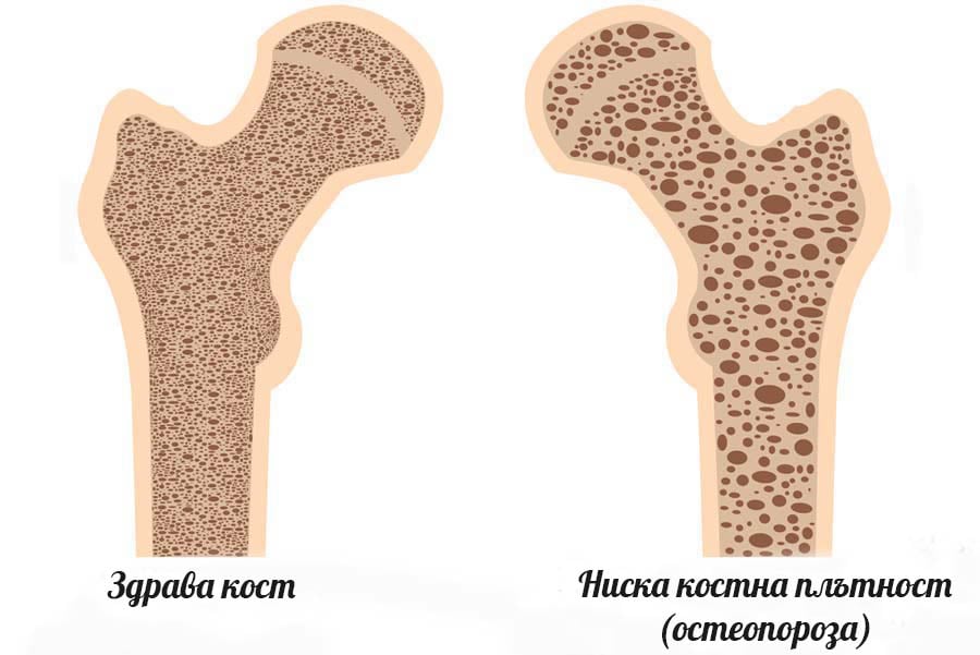 Загуба на костна плътност.