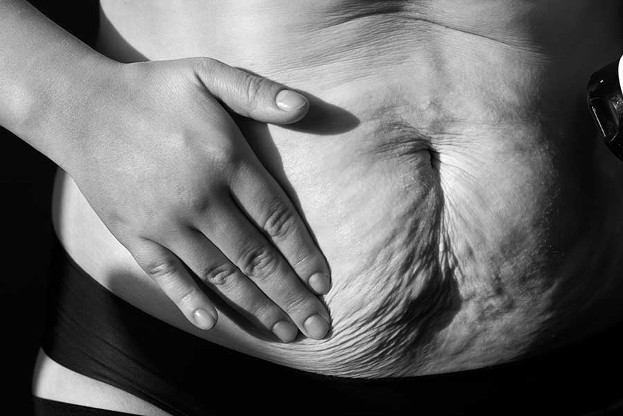 otpusnata-koja-otslabwane Отпусната кожа след отслабване.