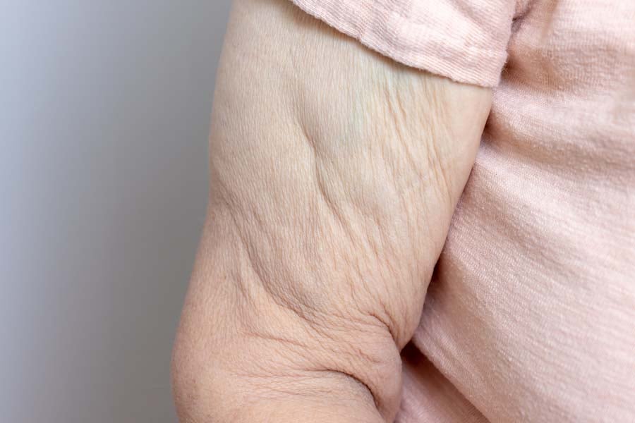 Отпусната кожа след отслабване - как да я стегнем? 8 отпусната кожа след отслабване