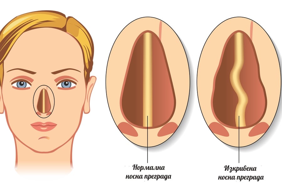 Изкривена носна преграда - лечение.
