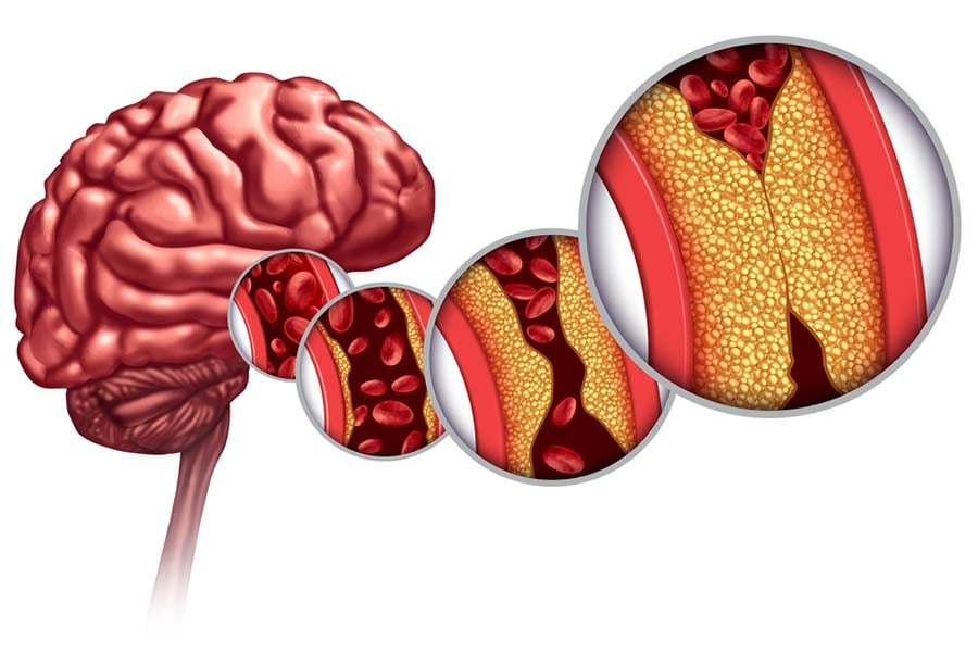 Оросяване на мозъка атеросклероза