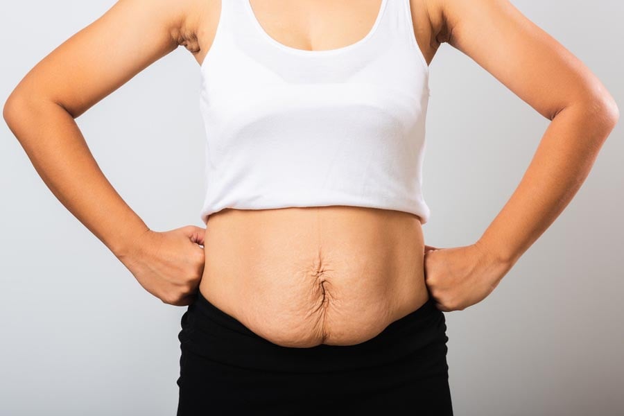 Отпусната кожа след отслабване - как да я стегнем? 9 отпусната кожа след отслабване