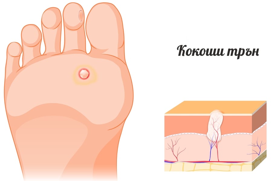 Кокоши трън - симптоми.