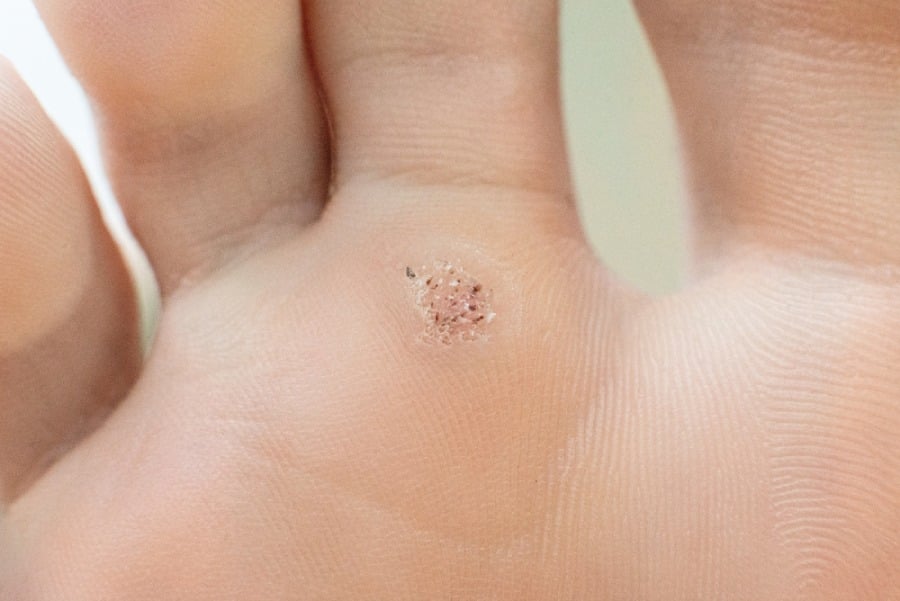 Кокоши трън на петата.