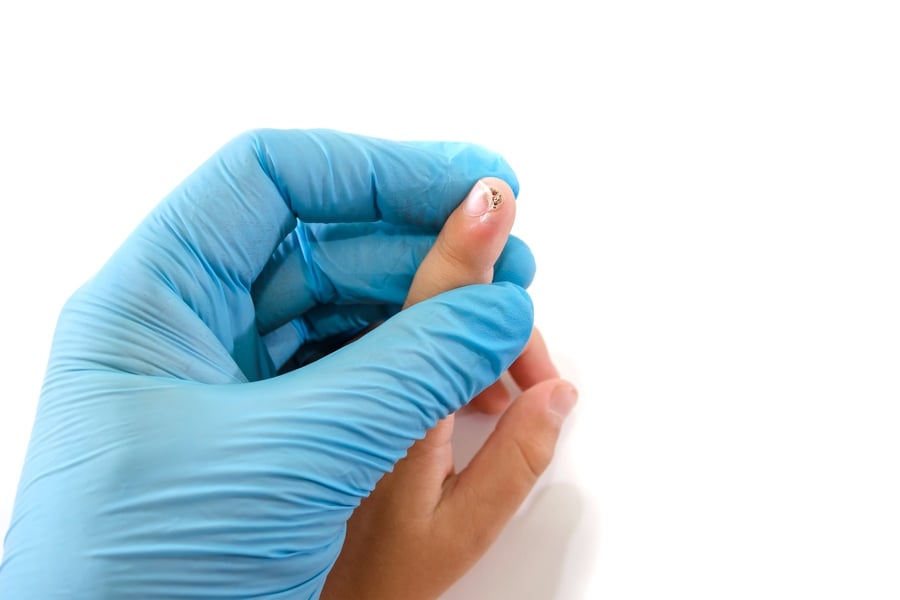 Кокоши трън - преглед.