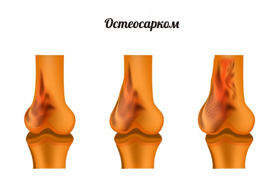 Остеосарком - симптоми.