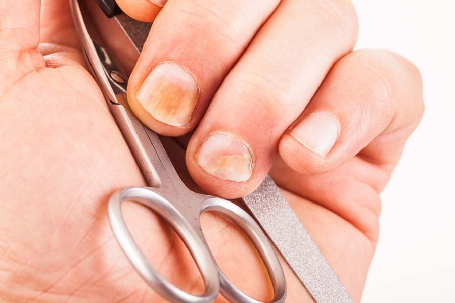 Гъбички по ноктите на ръцете – как да се справим? 5 гъбички по ноктите на ръцете