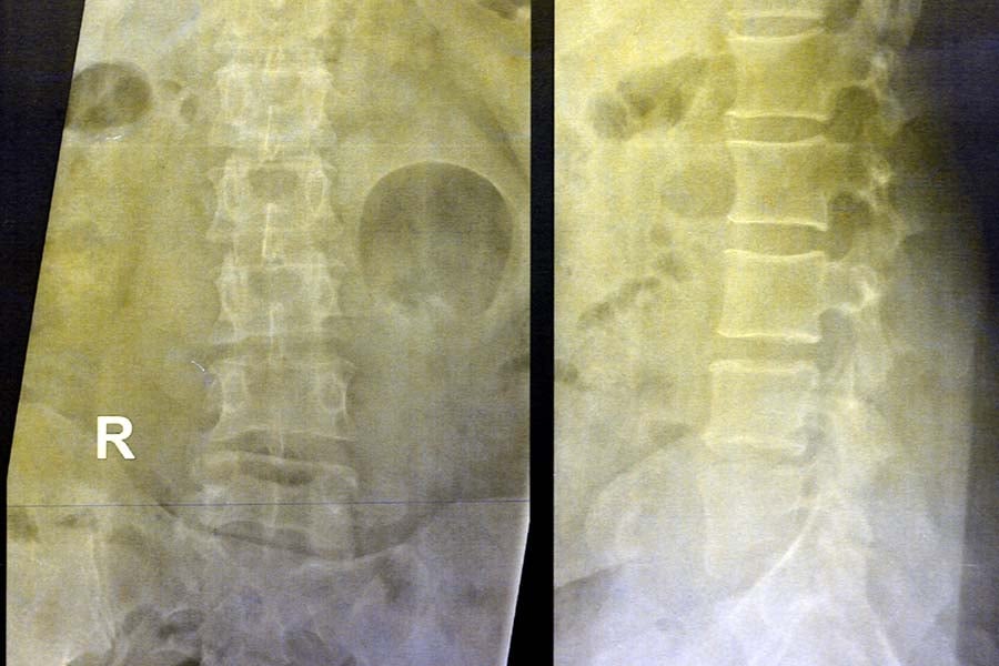 Остеосарком.