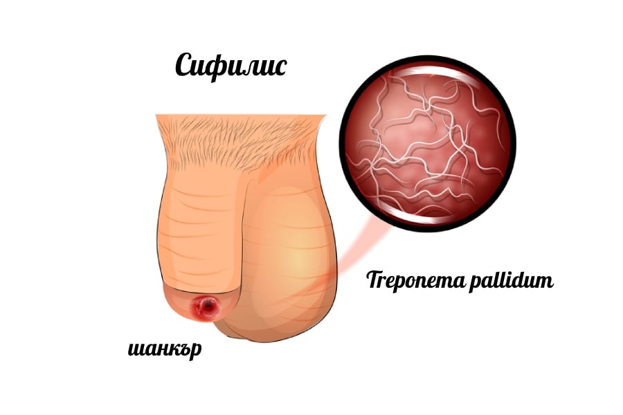Сифилис при мъжете - шанкър.