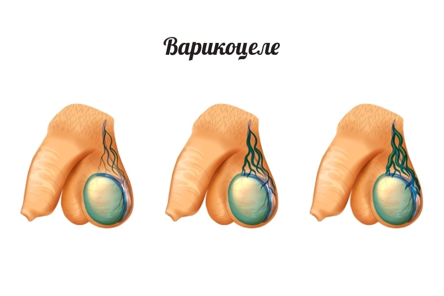 Варикоцеле – разширени вени.