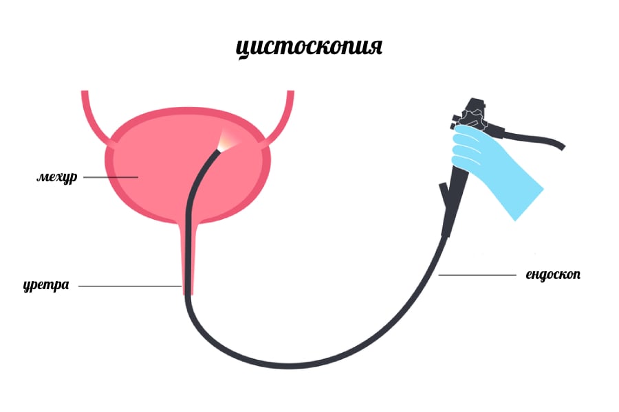 Възстановяване след цистоскопия.