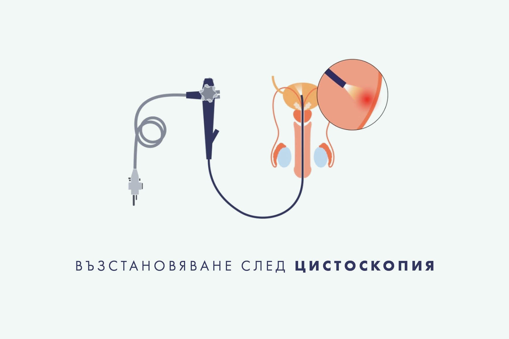 vuzstanovqvane-sled-cistoskopiq Възстановяване след цистоскопия.