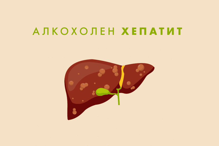 алкохолен хепатит