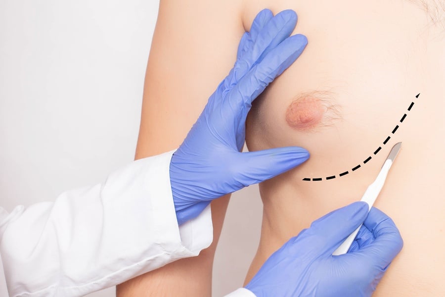 Гинекомастия, преглед