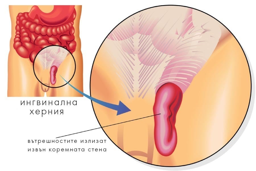 Ингвинална херния – илюстрация.