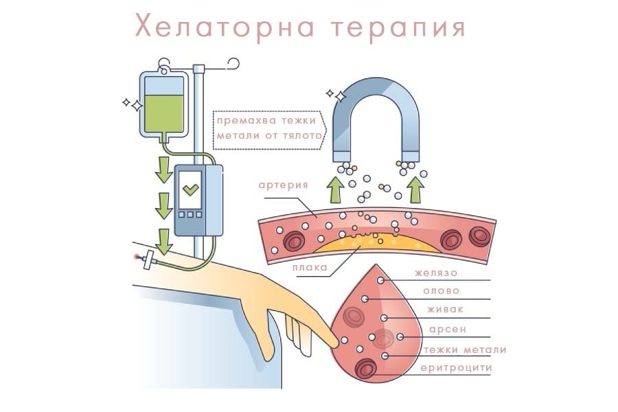 Процедура хелаторна терапия.