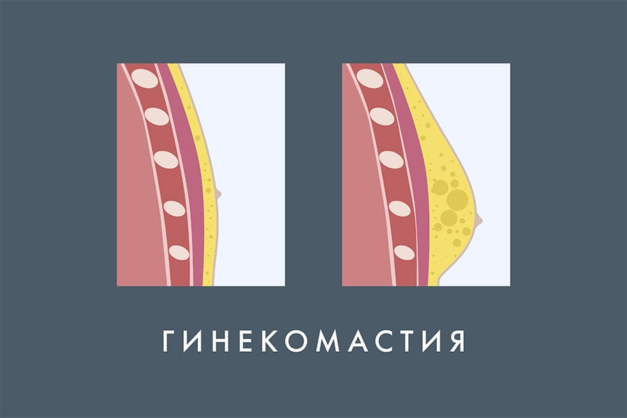 Гинекомастия.