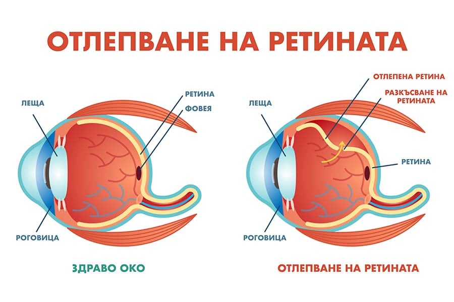 Отлепване на ретината.