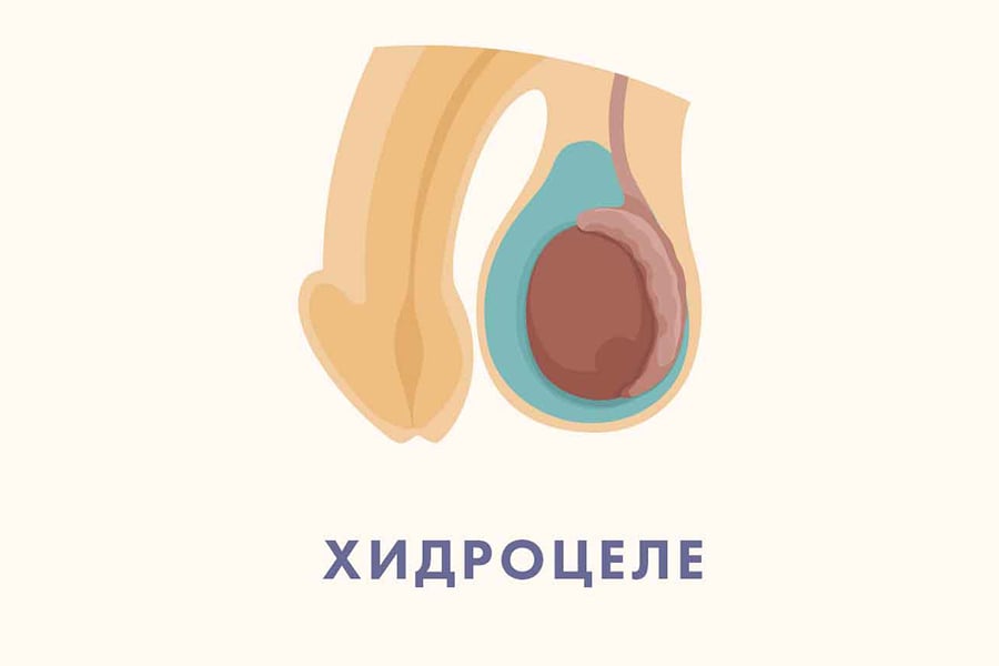 Хидроцеле.