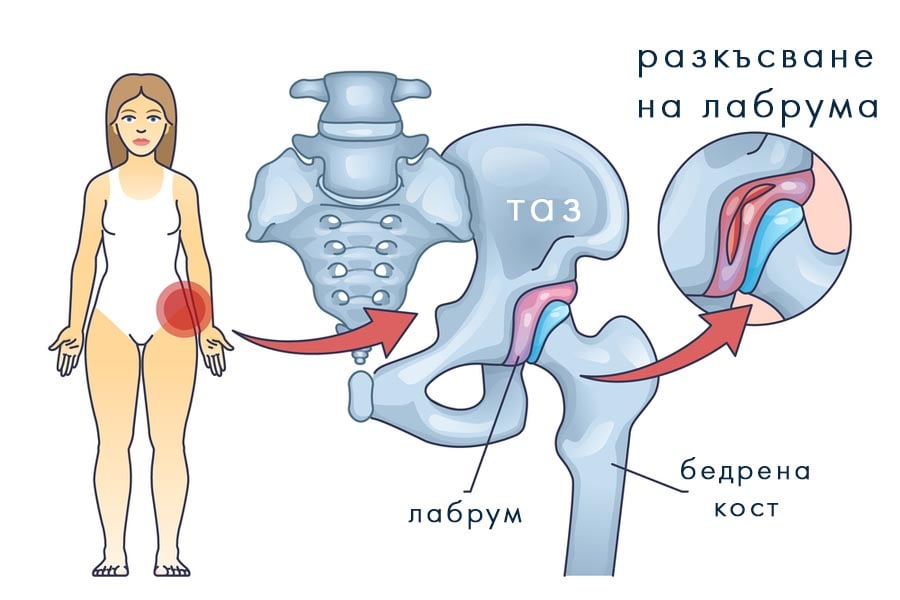 разкъсване на лабрум поради дисплазия на тазобедрената става