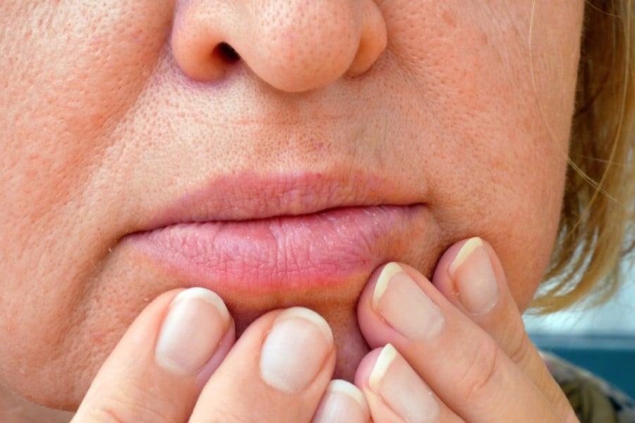 Какво е катарален стоматит? 8 Катарален стоматиг