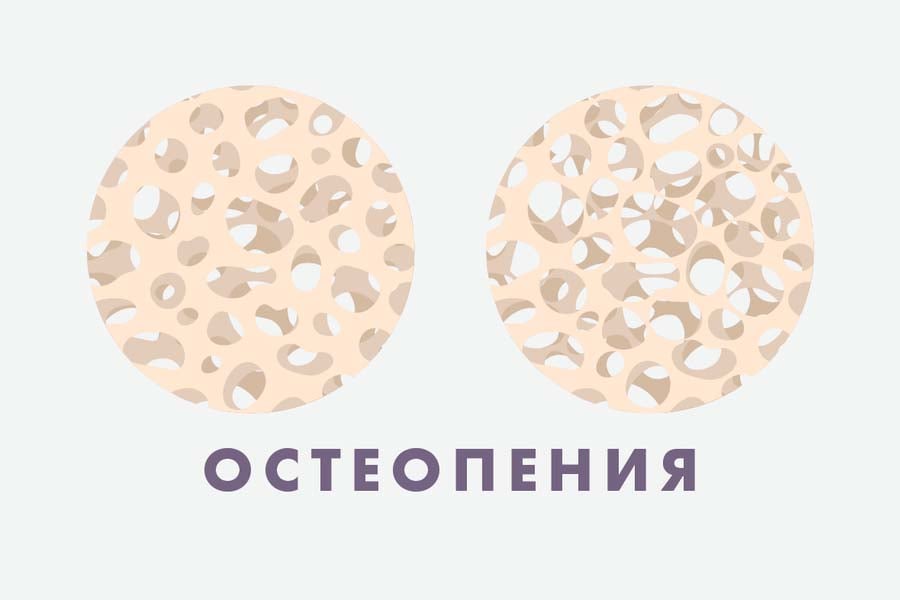 остеопения