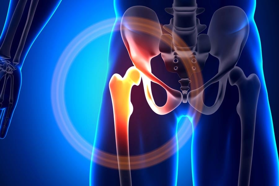 дисплазия на тазобедрената става